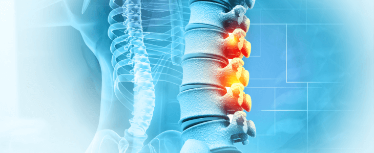 Epidural steroid injection