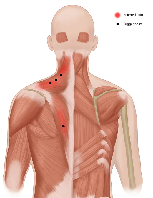 Trigger point injection