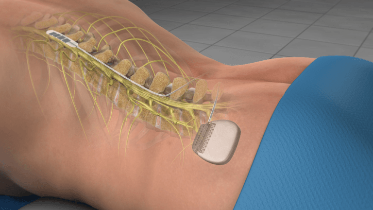 spinal cord stimulators